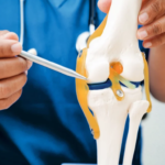 doctor con modelo anatómico de rodilla con osteoartritis